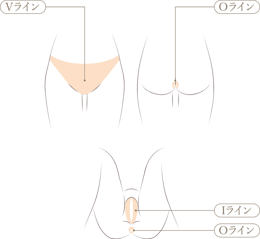 VIO脱毛施術部位